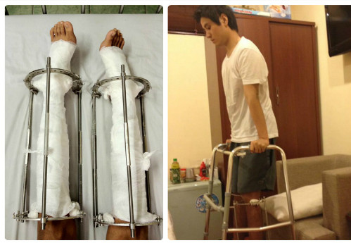 Chàng trai trải qua những ngày tháng đóng đinh cố định xương và tập đi tại nhà