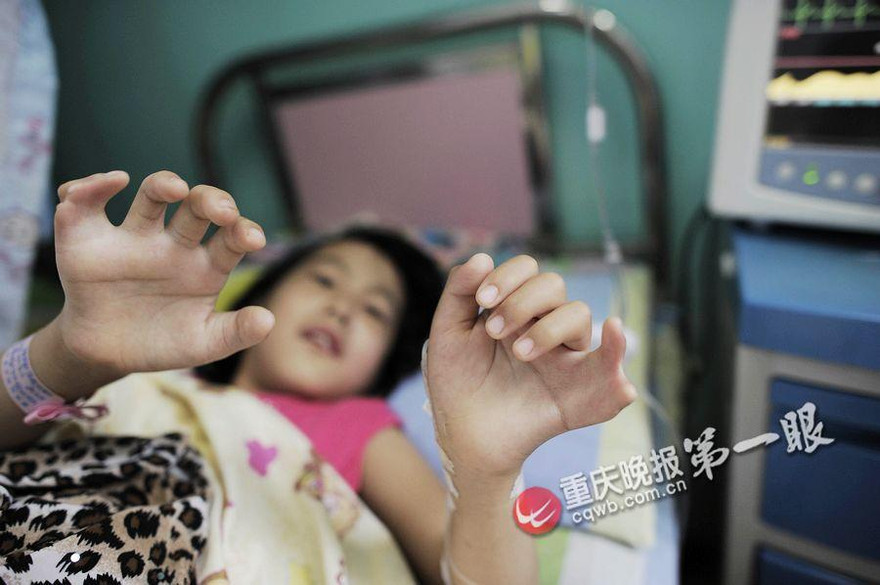 Bé gái có 15 ngón chân và 12 ngón tay