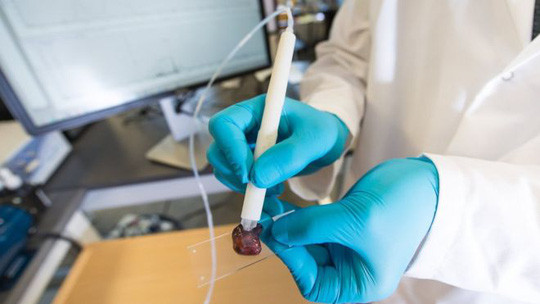 Bút chẩn đoán ung thư trong 10 giây