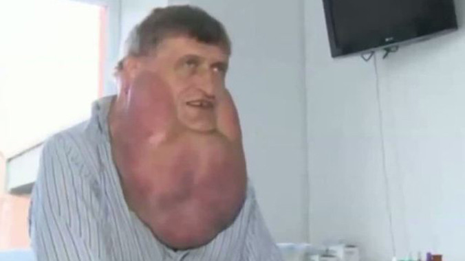 Người đàn ông có khối u lớn quanh cằm