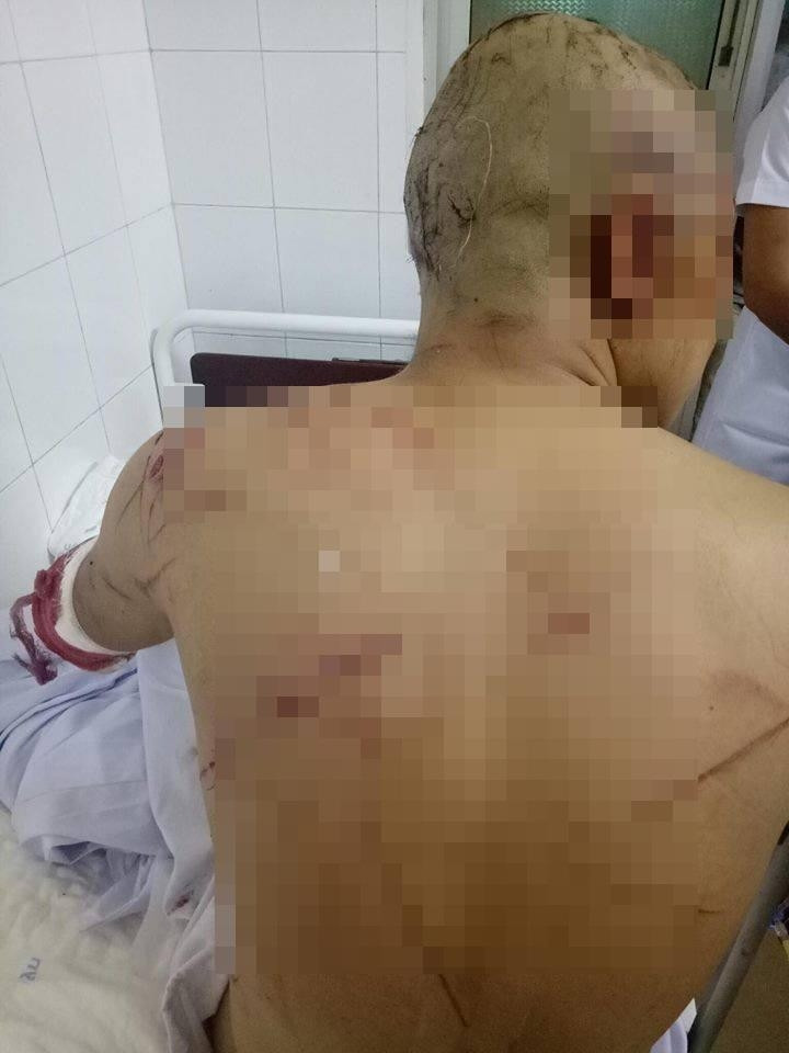 Cơ thể anh Hùng dày đặc vết thương sau vụ truy sát
