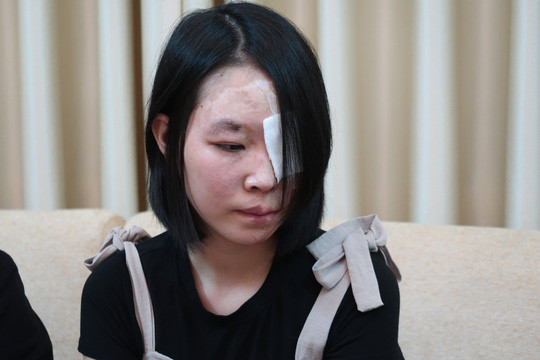 Khuôn mặt của nạn nhân bị biến dạng, hư mắt trái