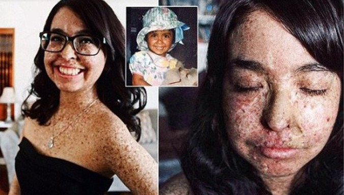 Andrea không dám ra ngoài vì sợ ung thư da. Ảnh: healthsina.