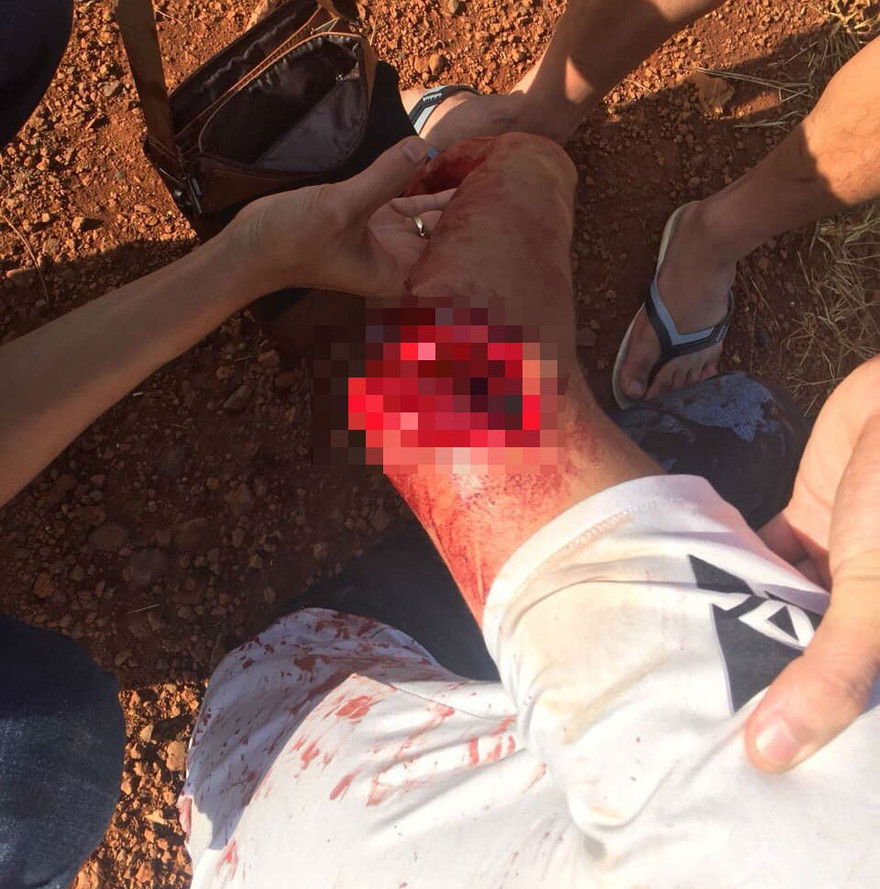 Một thanh niên bị chém trọng thương ở tay