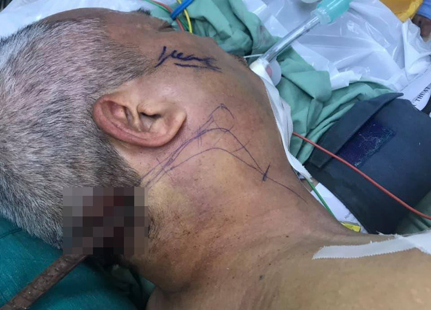 Ông Cường bị thanh sắt cắm vào vùng chẩm cổ xuyên ra đến tận góc hàm dưới.