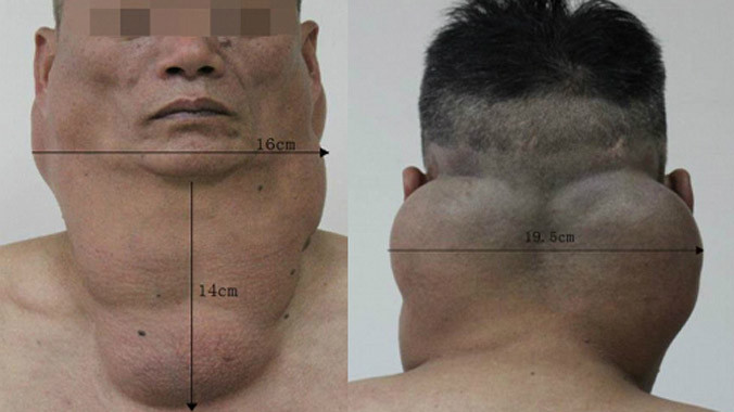 Các khối u của Hong. Ảnh: People's Daily.