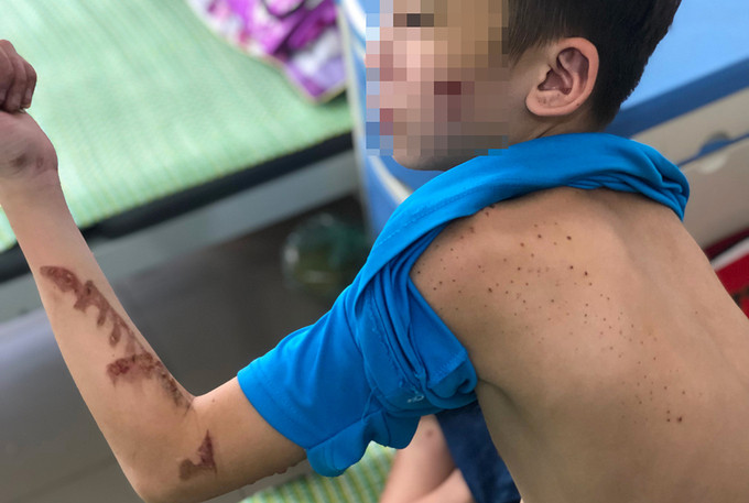 Duy đang điều trị các thương tích tại bệnh viện