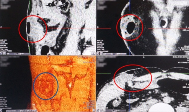 Hình ảnh chụp CT nạn nhân bị nhiều vết thương nguy hiểm.