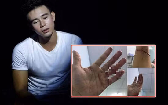 Đông Hùng và bàn tay bị chém rách khiến nhiều người xôn xao.