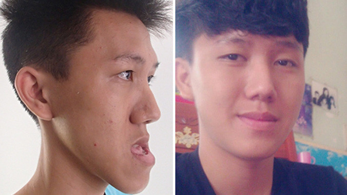 Khoa trước và sau khi được điều trị. Ảnh: Thy Châu.