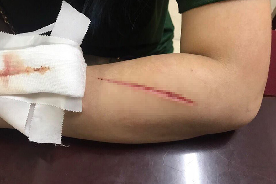 Hình ảnh vết thương trên tay thiếu nữ. Ảnh Công an cung cấp.