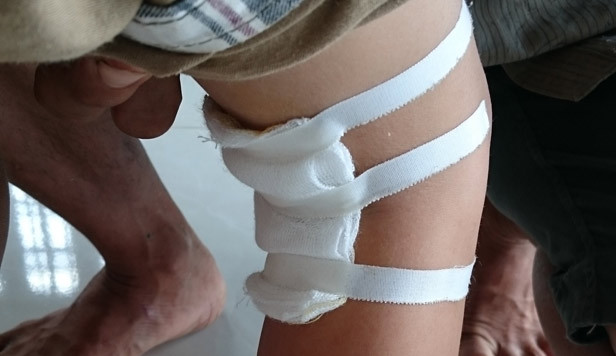 BS tự ý mổ chân phải bé Hào không thông báo gia đình.