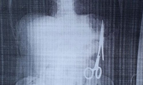Chiếc kéo được cho là đã nằm trong bụng bệnh nhân 18 năm. Ảnh: TTXVN.