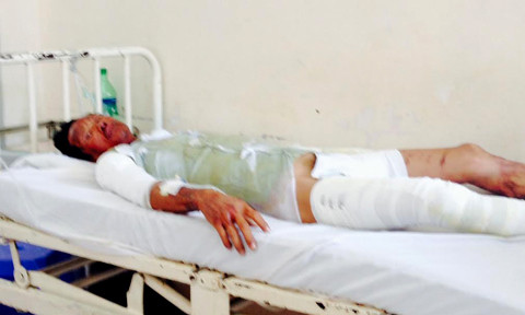 Đốt vợ, nhưng Lực cũng bị phỏng 40% diện tích cơ thể