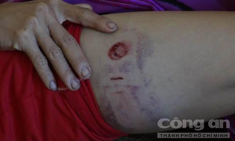 Hiện chị Minh đang được điều trị tại bệnh viện đa khoa huyện Phú Riềng, trong tình trạng đa chấn thương, rạn xương tay