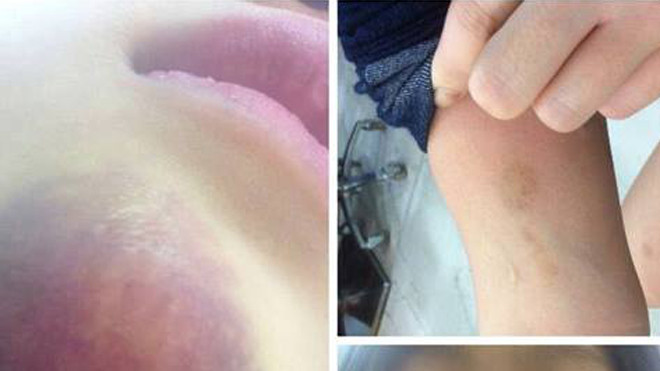 Vết thương trên cằm và tay nữ hành khách Q.A