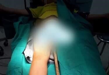 Thanh sắt đâm xuyên cơ thể cháu bé từ phía dưới.