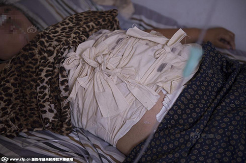 Bà Lý đã trải qua nhiều lần phẫu thuật bụng để lấy đinh ra. Ảnh: CFP.