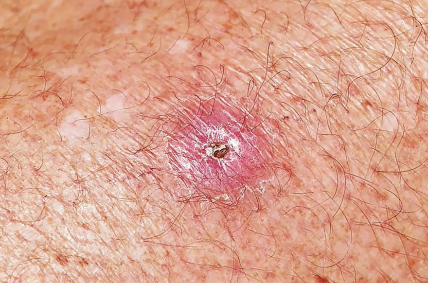 Sự bùng phát ổ dịch ăn thịt ở Úc, loét Buruli.