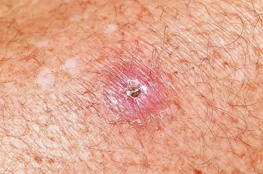 Sự bùng phát ổ dịch ăn thịt ở Úc, loét Buruli.