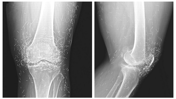 Phim chụp X-quang cho thấy, đầu gối của người bệnh có hàng trăm kim châm cứu bằng vàng