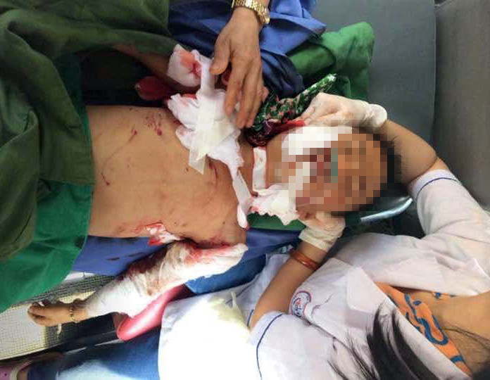Cháy G. bị chó cắn thương tích nặng. Ảnh: FB