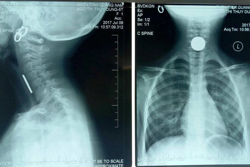 Gắp thành công đồng xu 500 đồng mắc kẹt trong thực quản bé gái.