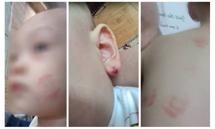 Bé Vũ Đức M. bị cắn chảy máu tai và tím má, lưng 
