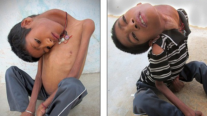 Xót xa cậu bé Ấn Độ cổ lệch 180 độ vì bệnh lạ