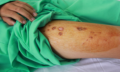 Vết cháy xém trên đùi em Vũ do bị điện giật