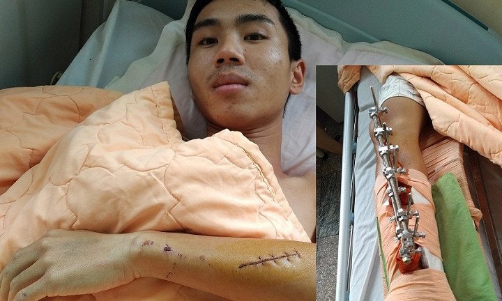 Lợi đang nằm điều trị tại bệnh viện - Ảnh: Tây Sơn 