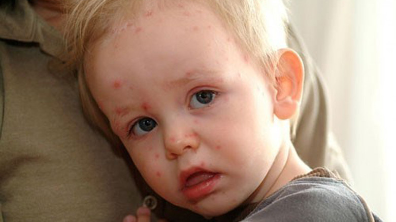 Thời tiết nắng nóng khiến trẻ bị rôm sảy.