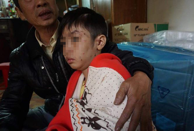 Cháu K vẫn chưa hết sợ hãi từ những trận đòn của bố, hiện đang về ở cùng mẹ.