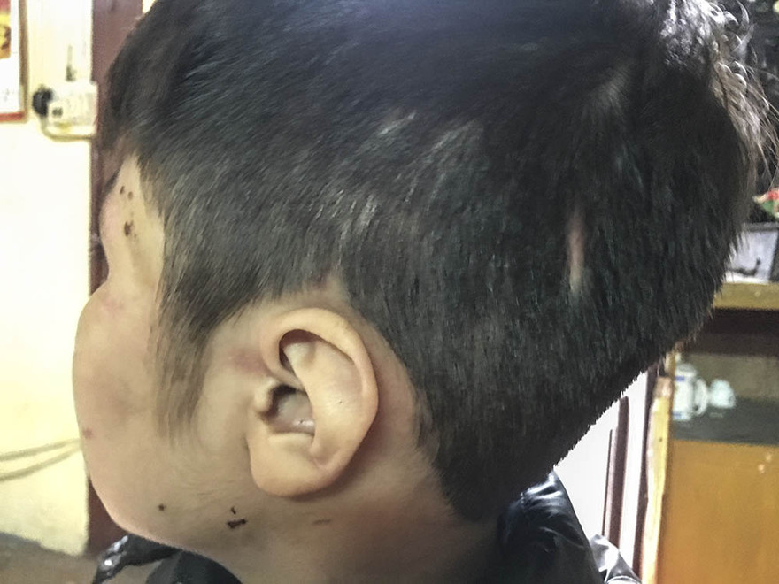 Trên khắp cơ thể bé K. (10 tuổi) chi chít những vết sẹo cũ lẫn mới chưa lành hẳn. Ảnh: Thanh Hà. 