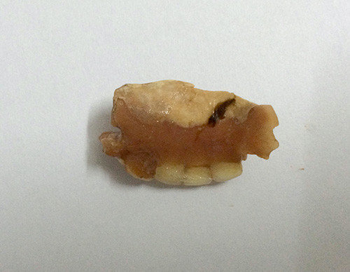 Khung hàm có 3 răng giả được lấy ra từ dạ dày cụ bà 60 tuổi. Ảnh: Đức Hùng.