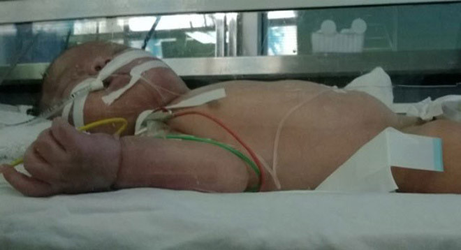 Bệnh nhi Khuất Tiến Minh đang điều trị tại Bệnh viện Nhi T.Ư. Ảnh: Infornet.