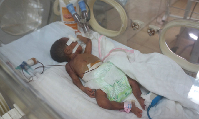 Bé gái được cấp cứu nhiều ngày trong lồng kính. Ảnh: Lê Hoàng/VnExpress