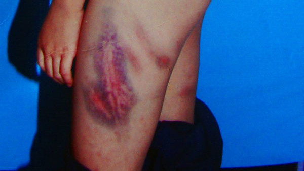 Hùng Anh và những vết thương 