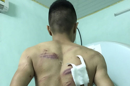 Anh Hưng với vết thương trên lưng