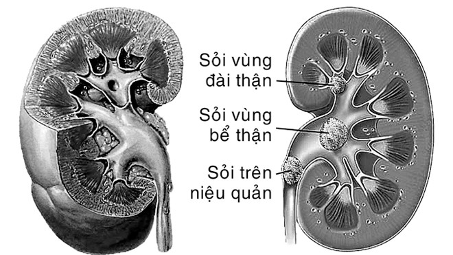 Sỏi thận - Ngăn ngừa tái phát trong điều trị