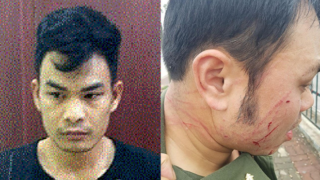 Hoàng Văn Trường và nhân viên sân bay bị hành hung gãy 4 răng cửa.