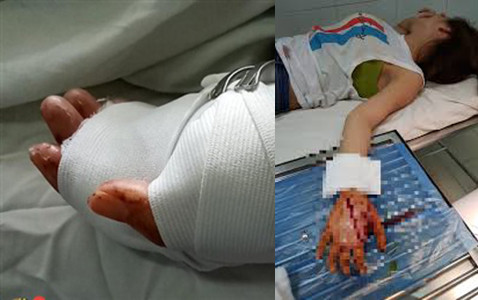 Bàn tay nạn nhân đã được bác sĩ băng bó