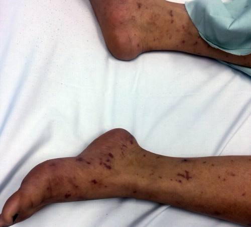 Chấm xuất huyết hoại tử hình sao rất đặc trưng của bệnh viêm màng não do não mô cầu. Ảnh: Bệnh viện cung cấp