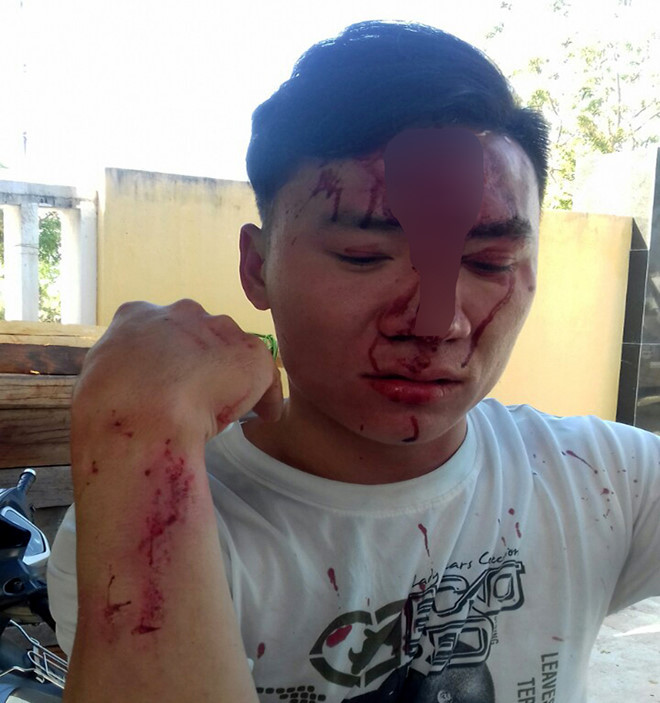 Anh Xuân bị đánh gãy xương mũi. Ảnh: Kiểm lâm cung cấp
