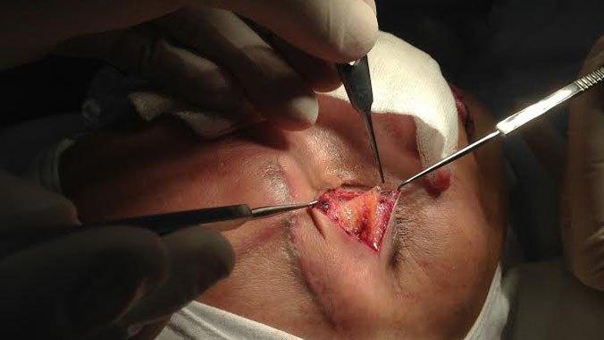 Kinh hoàng silicon chui lên hốc mắt