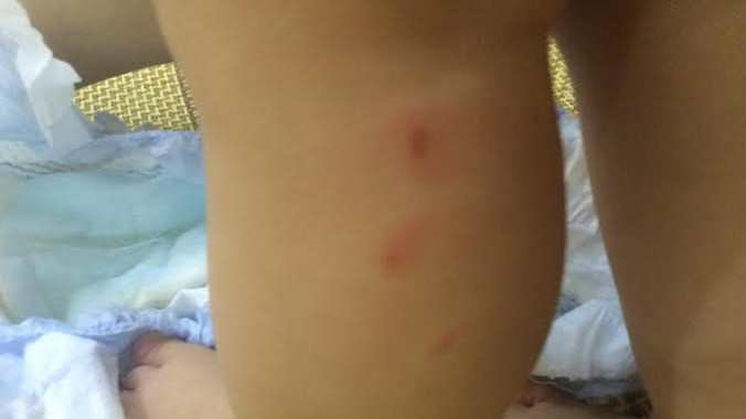 Vết xước trên chân bé K.N khi được gia đình đón về chiều 15/6.