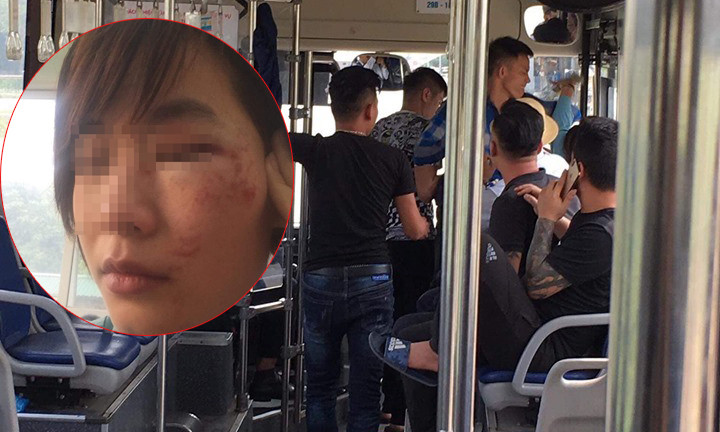 Chị H. bị 4 thanh niên đánh bầm dập.