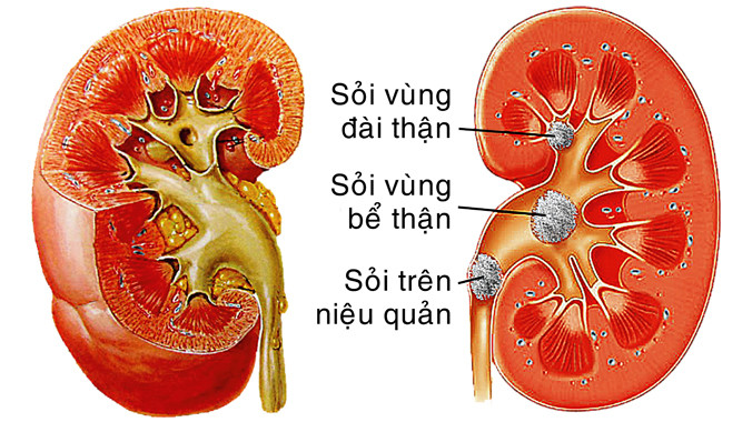 Sỏi thận - Ngăn ngừa tái phát trong điều trị