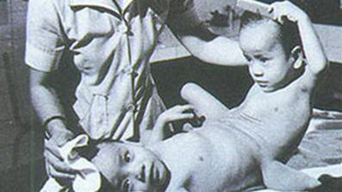 Chuyện chưa kể về ca mổ lịch sử tách cặp song sinh Việt - Đức