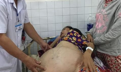 Bà M phải chịu đựng khối u “khủng” nặng 40kg suốt gần 10 năm trời. Ảnh do bệnh viện cung cấp.